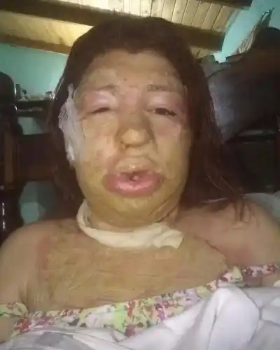 Sobrevivió a un ataque con fuego y denunció nuevos episodios de violencia en Posadas: “Temo por mi vida y la de mis hijos”