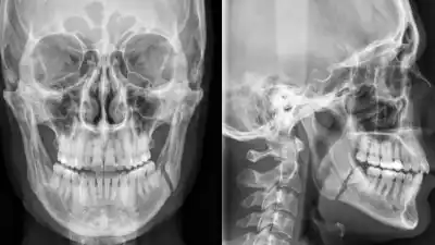 Brutal agresión en Pampa Blanca: un joven terminó con la mandíbula fracturada y quedó internado en el Pablo Soria