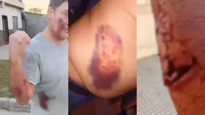 Trabajador de 51 años denunció un brutal ataque de perros pitbull en el barrio Borges