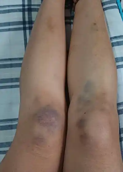 Iba en bici y un motociclista la tiró: ahora busca las cámaras que lo delaten