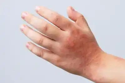 La picazón que no da tregua: por qué la dermatitis atópica creció en los últimos años