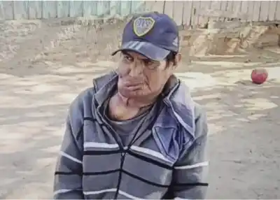 Viajó desde Embarcación para tratar un cáncer bucal y hay un pedido urgente que depende de todos