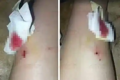El perro que ya había atacado a un chico volvió a morder: ahora la víctima es una vecina