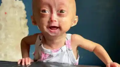 La gemela que conmovió al mundo con su sonrisa murió a los cinco años