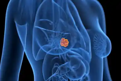 Se curaron del cáncer de mama, pero cinco años después sus arterias siguen mostrando una huella