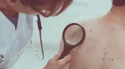 El hospital Madariaga abre turnos gratis para revisar lunares: la advertencia de los dermatólogos