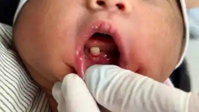 El caso del bebé que nació con dientes en Jujuy: por qué la odontopediatra decidió extraerlos a los 3 días