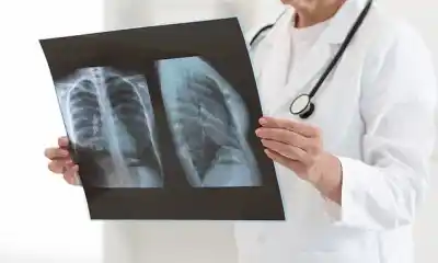 El cáncer que ya no responde al perfil clásico: crecen casos en personas que nunca fumaron