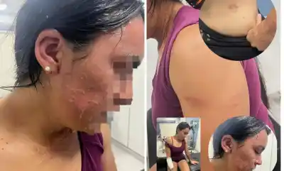 Violento ataque con agua hirviendo desata conflicto familiar y versiones encontradas