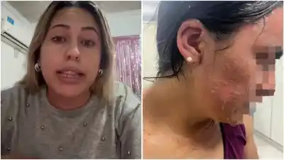 La mujer señalada por el ataque con agua hirviendo rompió el silencio: “Nos quemamos las dos”