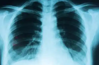 El síntoma que muchos confunden con una bronquitis y puede ser cáncer de pulmón