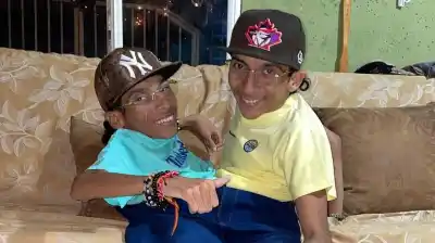 Los siameses que soñaban con caminar murieron juntos en Colombia: la frase que dejaron