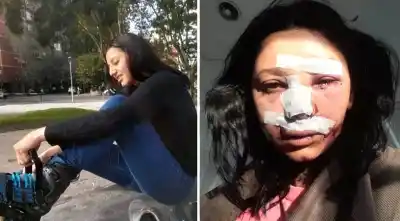 Un accidente en rollers le cambió el rostro para siempre: lo que vio en el espejo la dejó sin palabras