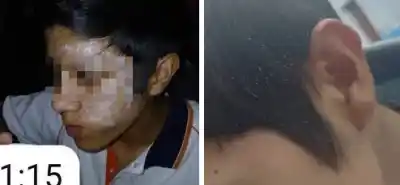 Jugaba con un desodorante y un encendedor: la peligrosa broma que dejó a un adolescente con el rostro quemado