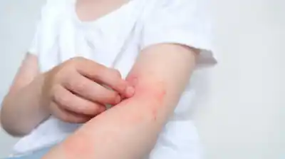 El dato que pocos conocen sobre la dermatitis atópica y que puede cambiar tu forma de verla
