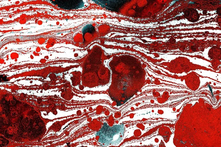Una ecografía de las arterias a los 40 años indica qué riesgo cardiovascular hay
