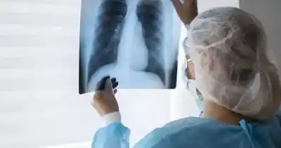 Alarma en Salta: es la provincia con la tasa más alta de tuberculosis del país