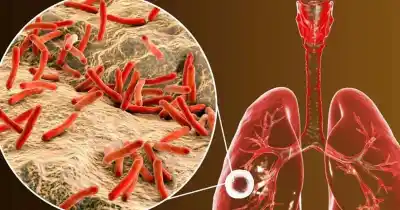 Alarma en Santa Fe: los casos de tuberculosis crecen un 32,9% y ya hay más de 6.400 contagios en el país