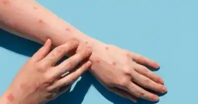 Alerta en San Juan: la mpox está de regreso y esto es lo que tenés que saber