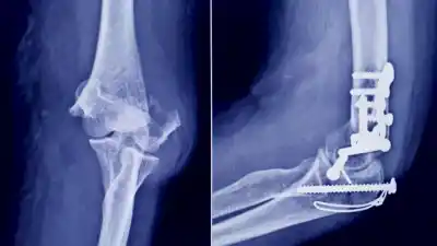 ANMAT detecta un tornillo quirúrgico falsificado en una ortopedia de San Miguel de Tucumán