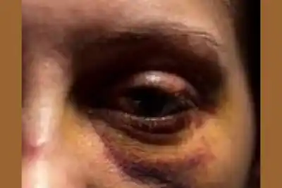 Salió a tomar con amigos y terminó con el ojo morado tras la furia de una mujer celosa