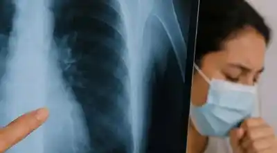 Alerta en Salta: 400 casos de tuberculosis y un detalle que preocupa a los médicos