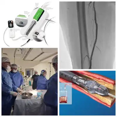 Un hito médico en San Luis: realizan por primera vez una aterectomía con sistema Jetstream