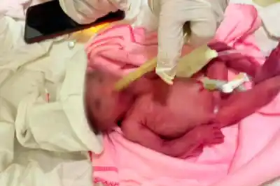 Nació en Quimilí una bebé de 500 gramos y 24 semanas de gestación