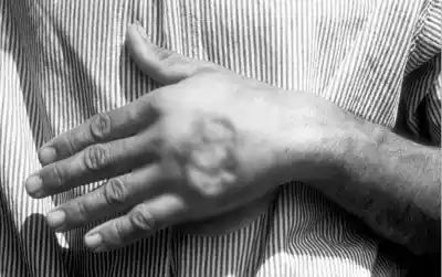 Alerta en Salta: 10 casos de leishmaniasis y un detalle que preocupa a los vecinos