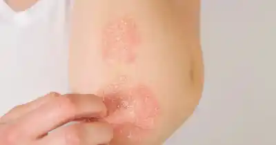 Atención gratuita en el Rawson: cómo acceder a los turnos para detectar psoriasis y artritis psoriásica