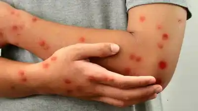 Alerta sanitaria en San Juan: detectan un caso de viruela del mono y la provincia queda bajo la lupa