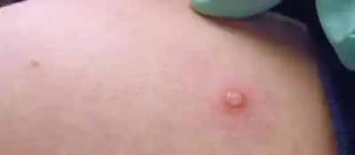 Alerta en San Juan: el primer caso de mpox y el detalle que tranquiliza a todos