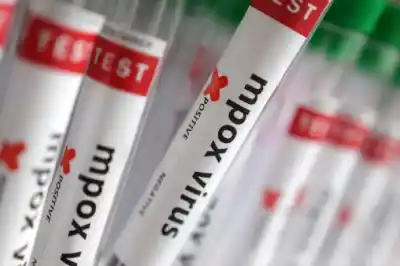 Alerta sanitaria en Argentina: Detectan el primer caso de un peligroso subtipo de viruela del mono