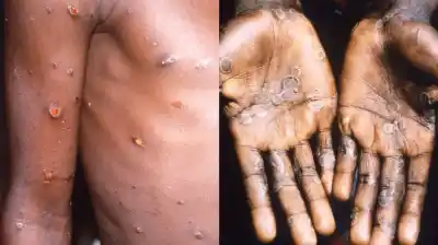 Alerta sanitaria en Argentina: Detectan por primera vez la variante más contagiosa de la viruela del mono
