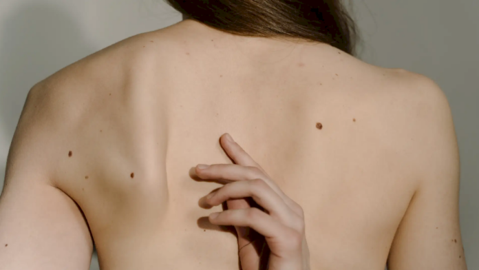 el-test-viral-de-los-lunares-en-el-cuerpo-que-revela-como-te-ven-los-demas